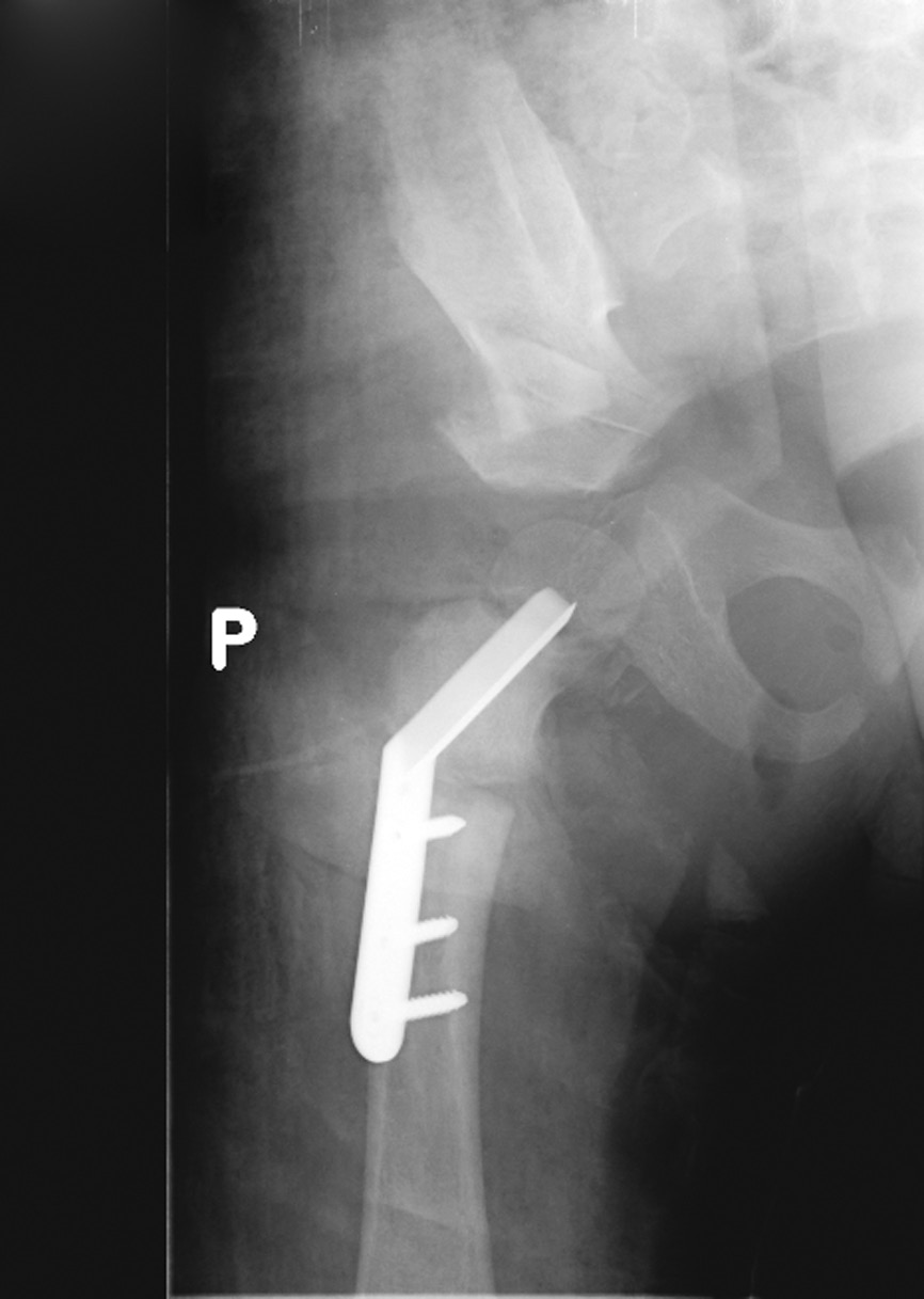 Ryc. 3. Zdjęcie rtg po operacji super hip/super knee (korekcja ustawienia bliższego końca kości udowej, osteotomia transiliakalna miednicy według Degi).