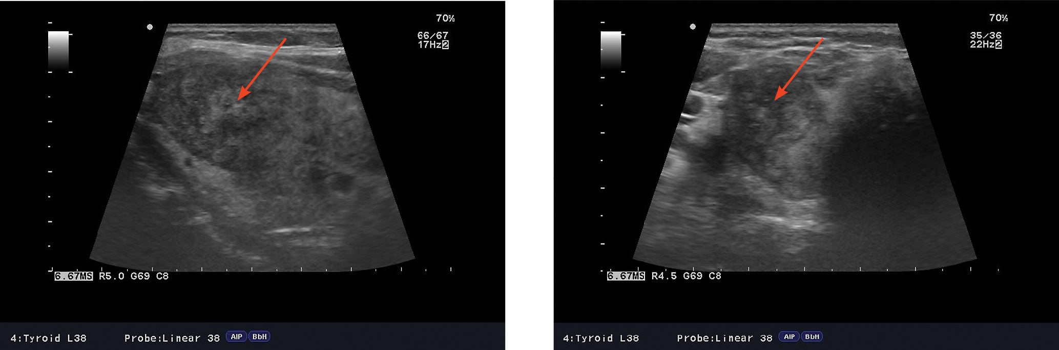 Rycina 1A,B. Obraz ultrasonograficzny charakterystyczny dla początkowej fazy podostrego zapalenia tarczycy