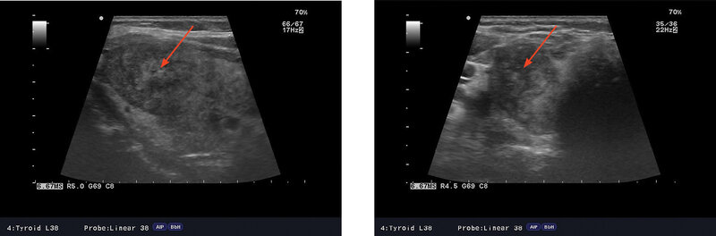 Rycina 1A,B. Obraz ultrasonograficzny charakterystyczny dla początkowej fazy podostrego zapalenia tarczycy