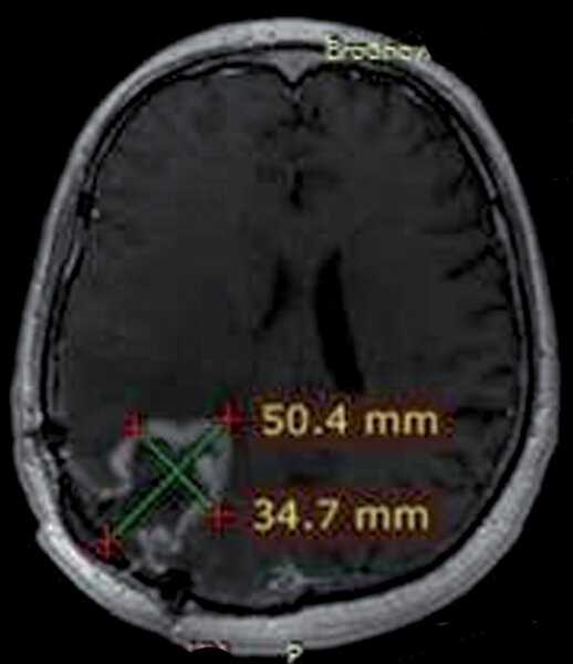 2. Badanie MRI 6 tygodni po pierwszym podaniu 213Bi-SP.
