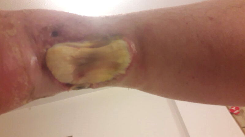 Rycina 1. Okolica prawego stawu skokowego. Strona tylna. Radioterapia 45 lat temu z powodu hemangioendothelioma dystalnego odcinka piszczeli. Stan po leczeniu ropnia (zakażonego krwiaka) okolicy ścięgna Achillesa. Ubytek skóry i tkanki podskórnej z odsłoniętym, ulegającym martwicy ścięgnem Achillesa. Obraz 4 tygodnie po ostatnim opatrunku typu VAC