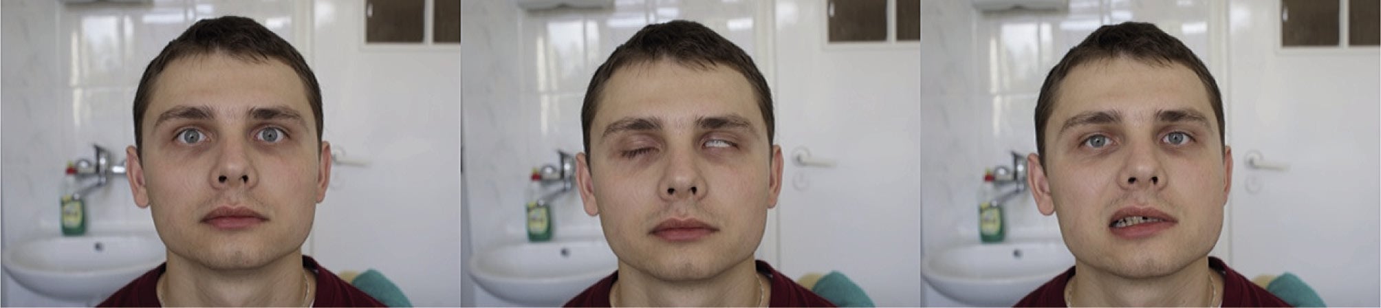 Rycina 4. Obustronne niejednoczesne porażenie nerwu VII. Chory nie marszczy czoła, nie zamyka powiek (asymetria szpar powiekowych), nie szczerzy zębów (asymetria kącika ust P<L).