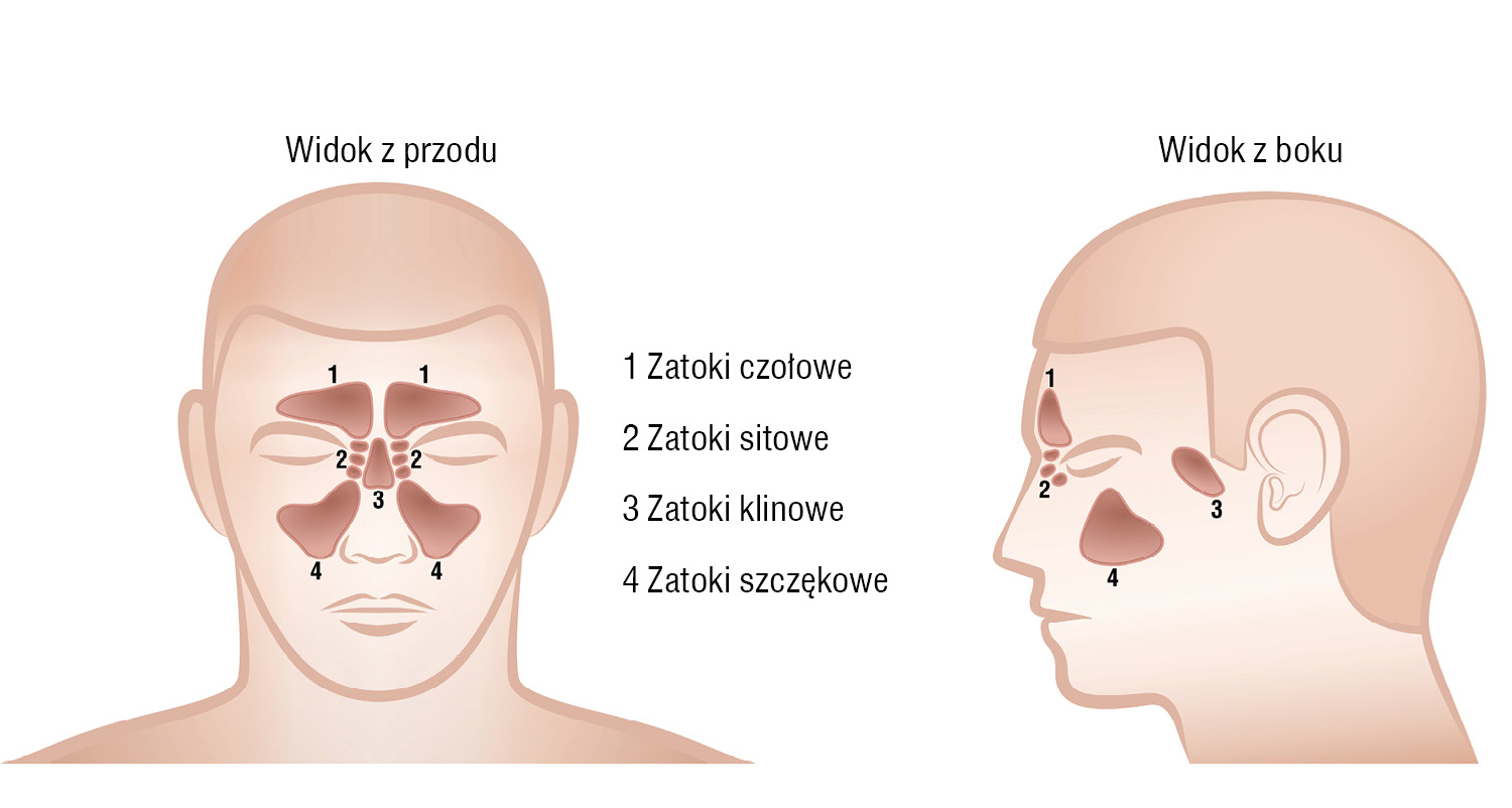 Zapalenie zatok