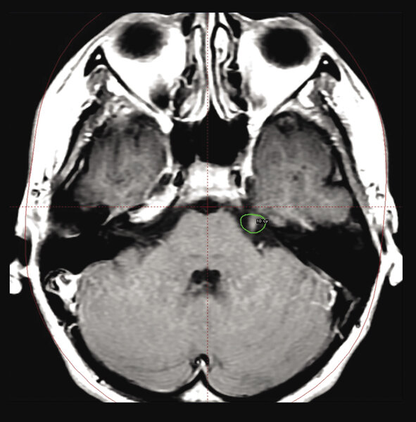 Rycina 2. Kontrolny rezonans magnetyczny po leczeniu radiochirurgicznym gamma knife pacjenta z neuralgią nerwu trójdzielnego lewego. Widoczny jest obszar wzmocnienia kontrastowego w zakresie pnia nerwu trójdzielnego  po 6 miesiącach od napromieniania