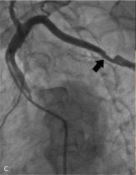 Rycina 1. Angio-TK aorty [A], tętnic biodrowych i udowych [B] oraz angiogram lewej tętnicy podobojczykowej [C]. Czarną strzałką oznaczono ok. 50% zwężenie w tętnicy podobojczykowej lewej.