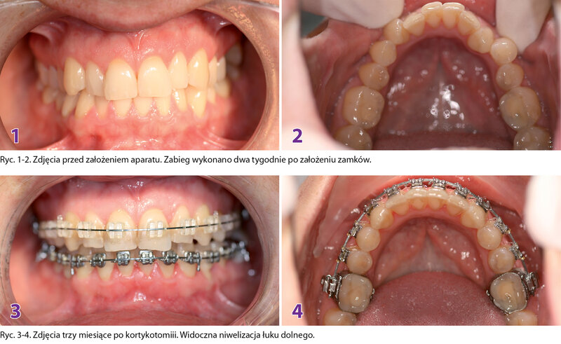 PRZYPADEK 1. Pacjentka P.J., lat 35, z klasą I Angle’a, stłoczeniami w łuku górnym i dolnym, cienkim biotypem dziąsła. Plan leczenia zakładał kortykotomię w łuku dolnym, z płatem zewnętrznym od zęba 34 do 44.