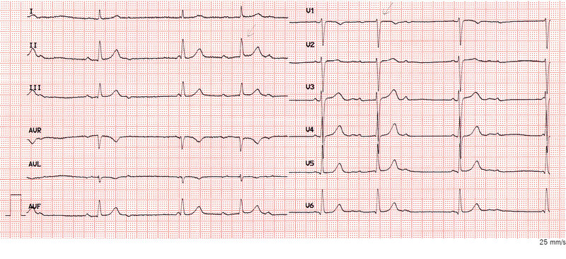  Elektrokardiogram&nbsp;1.