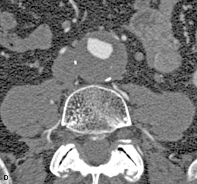 RYCINA 1. Angiografia TK (rekonstrukcje VR [A] i MIP [B]) tętnic obwodowych, angiografia TK (rekonstrukcja VR) serca i tętnic wieńcowych [C] oraz angiografia TK aorty (warstwa poprzeczna na poziomie tętniaka aorty brzusznej) [D] u pacjenta z podejrzeniem choroby wieńcowej. Badanie uwidoczniło prawidłowy obraz tętnic wieńcowych, rozwarstwienie w tętniaku aorty brzusznej, obecność podwójnych tętnic nerkowych, krytyczne zwężenie lewej tętnicy biodrowej wspólnej (Kardiol Dypl 2006; 5 (4): 97-100).