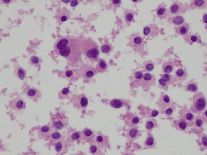 Fot. 2. Preparaty z biopsji aspiracyjnej cienkoigłowej – komórki  raka rdzeniastego tarczycy; HE pow. 200×. 