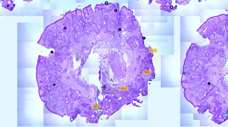 Rycina 4. Preparat histologiczny z pierwszego etapu wycięcia. Widoczne punkty orientacyjne zaznaczone barwnikami przez technika oraz dodatkowo w programie. Obszary nacieczenia nowotworowego zaznaczone cyfrowo w programie