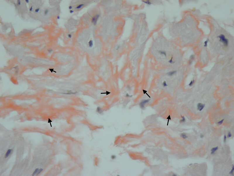 Rycina 10. Biopsja endomiokardialna. Kardiomiopatia restrykcyjna. Amyloidoza serca w barwieniu metodą czerwieni Kongo (strzałki – amyloid zabarwiony na kolor pomarańczowy)