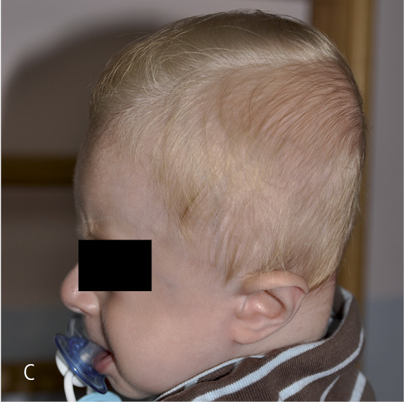 Rycina 11. Deformacja głowy w postaci spłaszczenia przednio-tylnego u małego dziecka (A), powiększona szerokość głowy w wyniku uwypuklenia płatów skroniowych (B) oraz zmniejszenie wymiaru długości głowy u starszego dziecka (C).