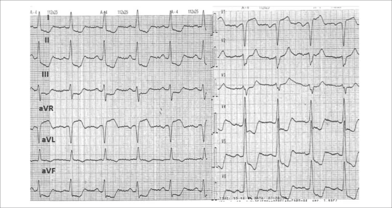 Rycina 6. EKG 24-letniego mężczyzny przyjętego z obrzękiem płuc z bólem w klatce piersiowej. W przyłóżkowym badaniu echokardiograficznym wykazano ostrą niedomykalność zastawki aortalnej z powiększeniem jamy lewej komory do 74 mm, wtórną do ostrego infekcyjnego zapalenia wsierdzia zastawki aortalnej.