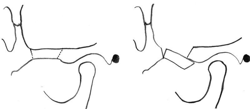 Ryc. 14. Schemat zabiegu osteoplastyki LeClerka.