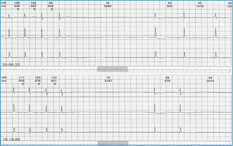 Rycina 1. Rejestracja EKG metodą Holtera u pacjenta z zespołem tachykardia-bradykardia i zasłabnięciami. Po zakończeniu napaduczęstoskurczu przedsionkowego następuje asystolia 3,3 sek (godz. 20.56.22) i 3,2 sek. (godz. 15.19.56) w mechanizmie zahamowania zatokowego