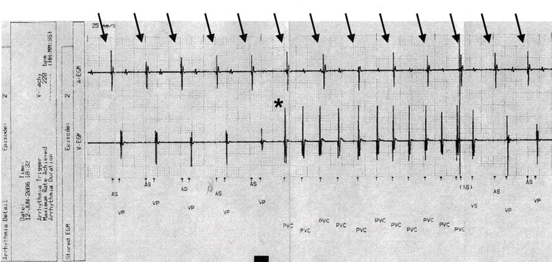  Rycina 5. Częstoskurcz komorowy (V-Tachy) zarejestrowany przez stymulator dwujamowy Guidant Insignia I Entra (Boston Scientific, Natick, Massachussets, USA). Przedstawiono elektrogram przedsionkowy (górny zapis) i komorowy (dolny zapis). Na samym dole zamieszczono zapis z kanału znaczników (czyli tego, co „widzi” stymulator), obejmujący 5 zdarzeń zarejestrowanych w kanale przedsionkowym (AS) oraz wystymulowanych pobudzeń komorowych (VP), a następnie krótki epizod częstoskurczu komorowego składającego się z 12 pobudzeń (oznaczonych w kanale znaczników jako przedwczesne pobudzenia komorowe [VPC]). Widoczne jest rozkojarzenie przedsionkowo-komorowe (strzałki wskazują załamki P, a gwiazdką zaznaczono początek częstoskurczu). AEGM – elektrogram przedsionkowy; EGM – elektrogram; VEGM – elektrogram komorowy; VS – zdarzenie zarejestrowane w kanale komorowym.