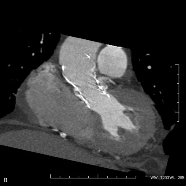 Rycina 5. Zastawka biologiczna CoreValve™ w ujściu aortalnym w przekroju poprzecznym i podłużnym.