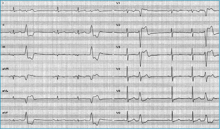 Rycina 4. Rejestracja skurczów dodatkowych komorowych w 12-odprowadzeniowym EKG u chorego bez organicznej choroby serca: morfologia zespołów QRS (wysokie zał. R w odpr. II,III i aVF oraz kształt zespołów QRS zbliżony do bloku lewej odnogi p. Hisa wskazują na drogę odpływu z prawej komory serca jako lokalizację ogniska arytmii. Łagodna forma arytmii komorowej