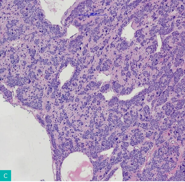 Rycina 4A-D. Obraz histologiczny gruczolakoraka brodawkowatego ekrynowego