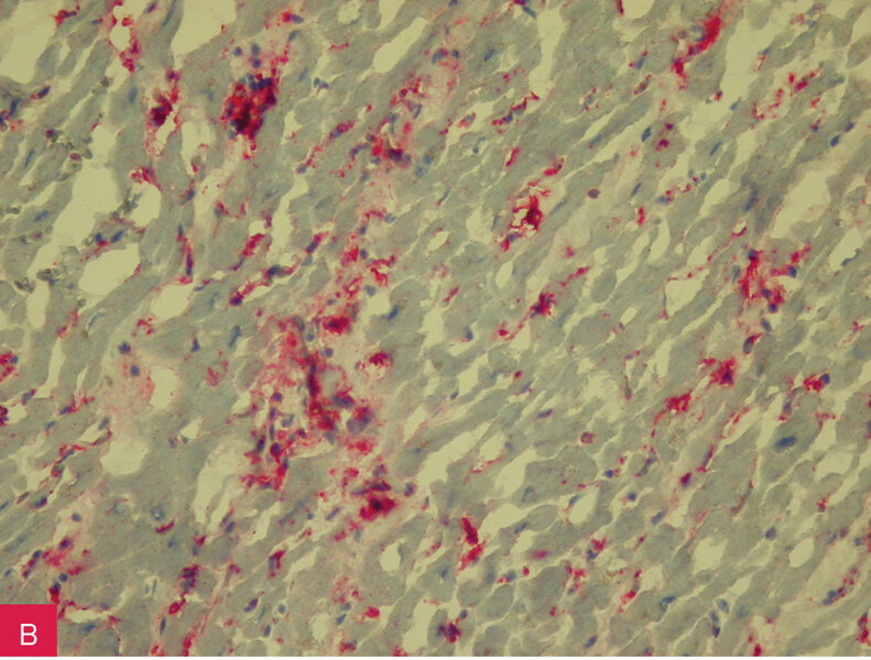 Rycina 1A i B. Przewlekłe aktywne zapalenie mięśnia sercowego (ZMS) w badaniu immunohistochemicznym skrawków mrożeniowych.  A. Silna, naczyniowa ekspresja antygenów HLA klasy I (A, B, C) z towarzyszącą stazą. B. Bardzo liczne uszkadzające nacieki makrofagalne (CD68+) z ogniskami martwicy kardiomiocytów