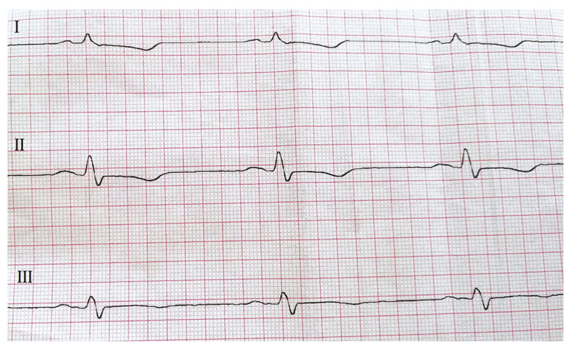 Rycina 2. Elektrokardiogram pacjentki z zawałem mięśnia sercowego bez uniesienia odcinka ST (NSTEMI). Przesuw 50 mm/s. Rytm zatokowy, 60/min, oś pośrednia, cechy martwicy w zakresie ściany przedniej (pacjentka po przebytym OZW-STEMI ściany przedniej), ostry zespół wieńcowy bez uniesienia odcinka ST ściany przedniej, istotne niedokrwienie w obrębie ściany dolnej. Istotne uniesienie odcinka ST w odprowadzeniu aVR – w koronarografii obraz choroby wieńcowej wielonaczyniowej