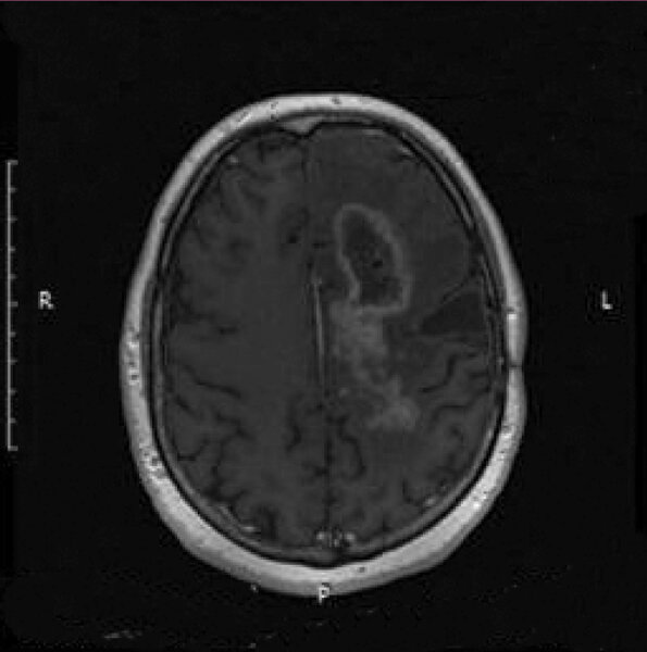2. Badanie MRI 6 tygodni po podaniu pierwszej dawki 213Bi-SP.