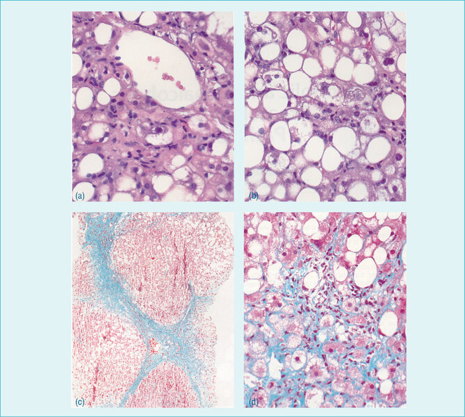  Rycina 1. Zmiany histologiczne w przebiegu niealkoholowego stłuszczenia wątroby: (a) akumulacja tłuszczu w hepatocytach, (b) obecność ciałek Mallory’ego oraz nacieki zapalne, (c) marskość i (d) klasyczne zwłóknienie okołokomórkowe
