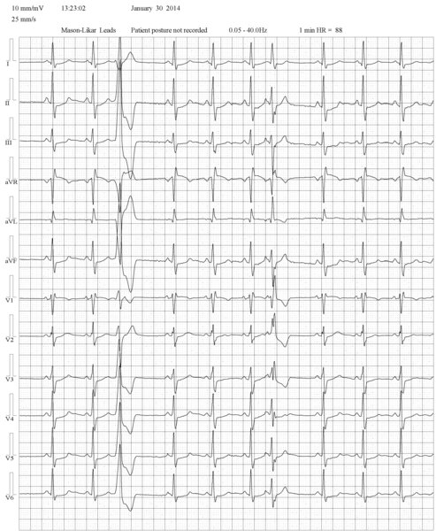 Rycina 2. Pierwsze pobudzenie przedwczesne jest pobudzeniem komorowym, widoczny załamek P rytmu zatokowego – tuż za QRS w V1, jest w „kroku” rytmu zatokowego. Ponadto R w V1 >30 ms, RS >60 ms. Drugie pobudzenie przedwczesne poprzedzone jest załamkiem P’, ponadto morfologia w V1 odpowiada RBBB – rSR’ oraz R >S w V6