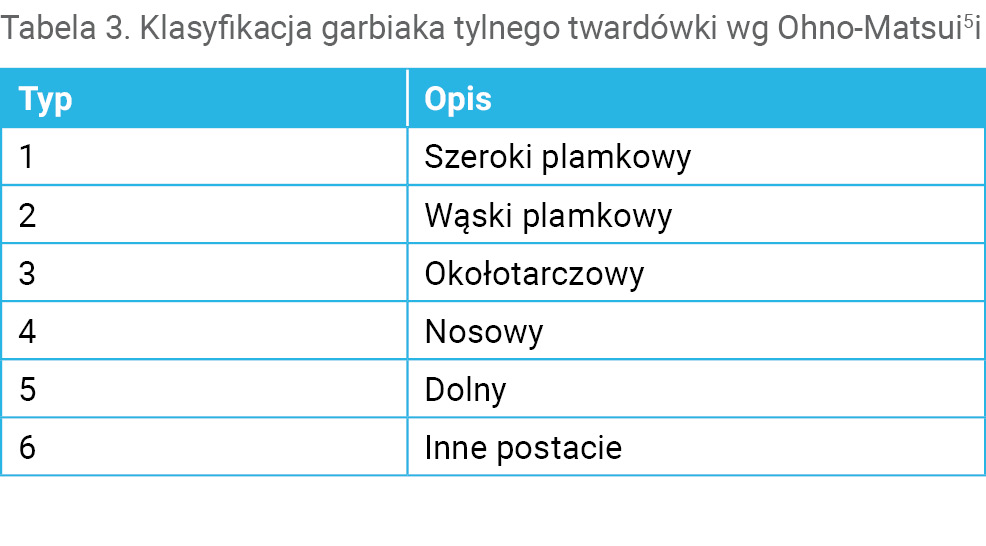 Tabela 3. Klasyfikacja garbiaka tylnego twardówki wg Ohno-Matsui5i