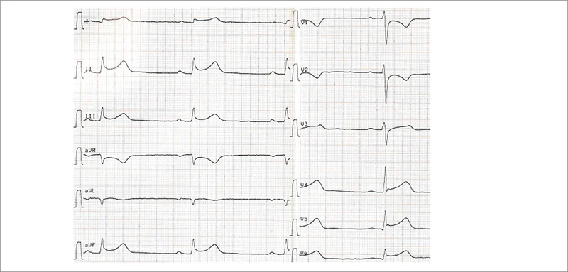 Rycina 3. EKG 21-letniego mężczyzny z zapaleniem osierdzia i mięśnia sercowego (dzięki uprzejmości dr Romany Furtak).