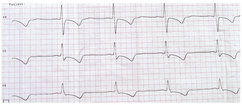 Rycina 2. Elektrokardiogram pacjentki z zawałem mięśnia sercowego bez uniesienia odcinka ST (NSTEMI). Przesuw 50 mm/s. Rytm zatokowy, 60/min, oś pośrednia, cechy martwicy w zakresie ściany przedniej (pacjentka po przebytym OZW-STEMI ściany przedniej), ostry zespół wieńcowy bez uniesienia odcinka ST ściany przedniej, istotne niedokrwienie w obrębie ściany dolnej. Istotne uniesienie odcinka ST w odprowadzeniu aVR – w koronarografii obraz choroby wieńcowej wielonaczyniowej
