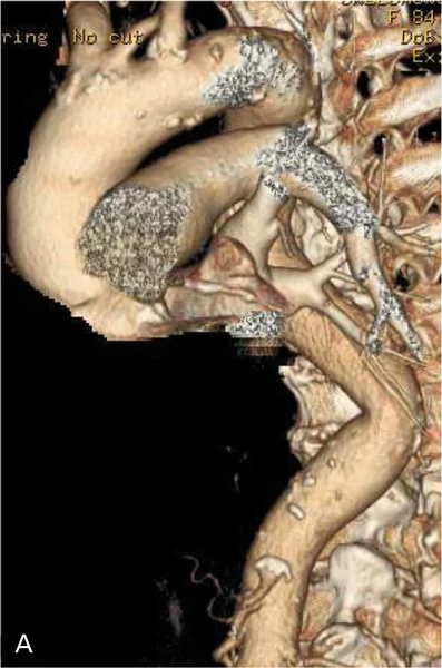 Rycina 1. Angio-TK aorty [A], tętnic biodrowych i udowych [B] oraz angiogram lewej tętnicy podobojczykowej [C]. Czarną strzałką oznaczono ok. 50% zwężenie w tętnicy podobojczykowej lewej.