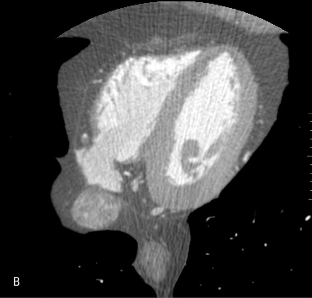 Rycina 2. Badanie tętnic wieńcowych metodą tomografii komputerowej. A. Rekonstrukcja MIP Inwers (maksimum intensity projection) – widoczne wielopoziomowe zmiany w prawej tętnicy wieńcowej. B. Warstwa poprzeczna (axial) – obraz remodelingu dodatniego ściany naczynia w segmencie 3 prawej tętnicy wieńcowej; blaszka niskiej gęstości zwęża światło w 40%, jednak jej faktyczna wielkość ukryta jest dzięki modelowaniu ściany naczynia na zewnątrz. 