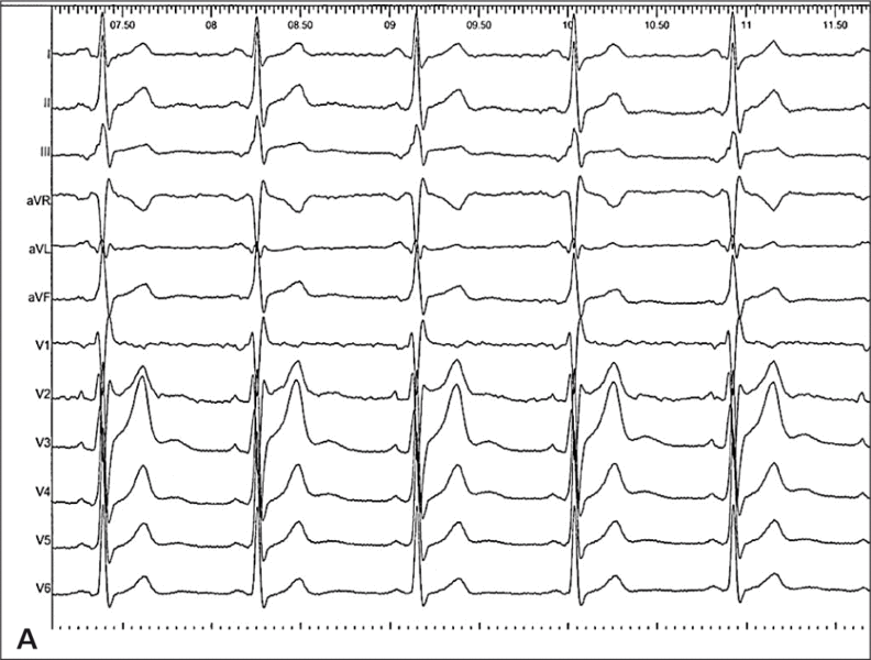 Rycina 1. [A] EKG wykonane w trakcie pierwszej hospitalizacji. Rozpoznano blok prawej odnogi pęczka Hisa. Pominięto objawy zespołu preekscytacji. [B] EKG zapisane w trakcie badania elektrofizjologicznego. Migotanie przedsionków z przewodzeniem do komór lewostronną drogą dodatkową. Bardzo krótkie odstępy RR 180-210 ms. Częstość zespołów QRS ok. 300/min.