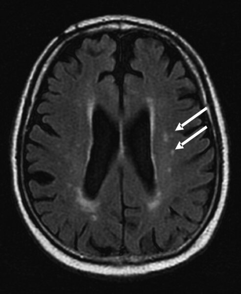 Ryc. 2. Ogniska lakunarne w MRI.