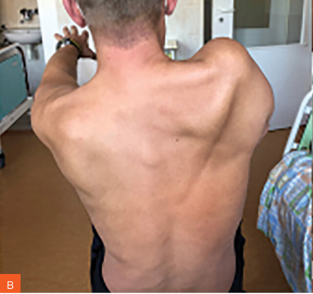 Rycina 5A-F. Jednostronne zaniki mięśniowe. A-D. Stan po miesiącu od ostrej fazy choroby. E, F. Stan po roku i wielomiesięcznej rehabilitacji porażenia czterokończynowego