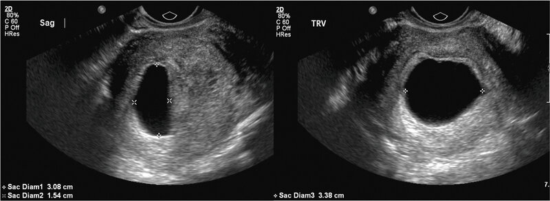 Rycina 3A. Wewnątrzmaciczny pęcherzyk ciążowy w ultrasonografii przezpochwowej. Średnia średnica pęcherzyka 26,7 mm. Obraz odpowiada  wczesnemu poronieniu typu ciąży bezzarodkowej