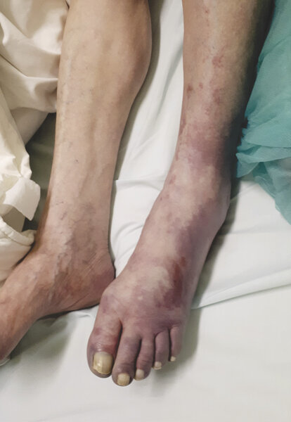 Rycina 2. Ostre niedokrwienie lewej kończyny dolnej trwające 7 dni