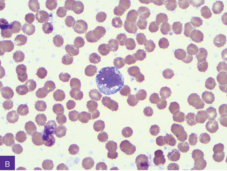 Rycina 10. Ziarnistość toksyczna w granulocytach obojętnochłonnych, wodniczki w monocytach. A. Neutrofil.  B. Monocyt. C. Granulocyt pseudopelgeropodobny