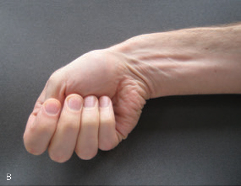 rizartroza kciuka remediu al durerii articulare la vârstnici