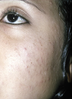 Small 3401 comedonal acne opt