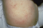 Small scabies opt