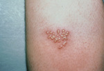Small herpes simplex 0508 opt