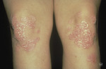 Small psoriasis on the legs  opt