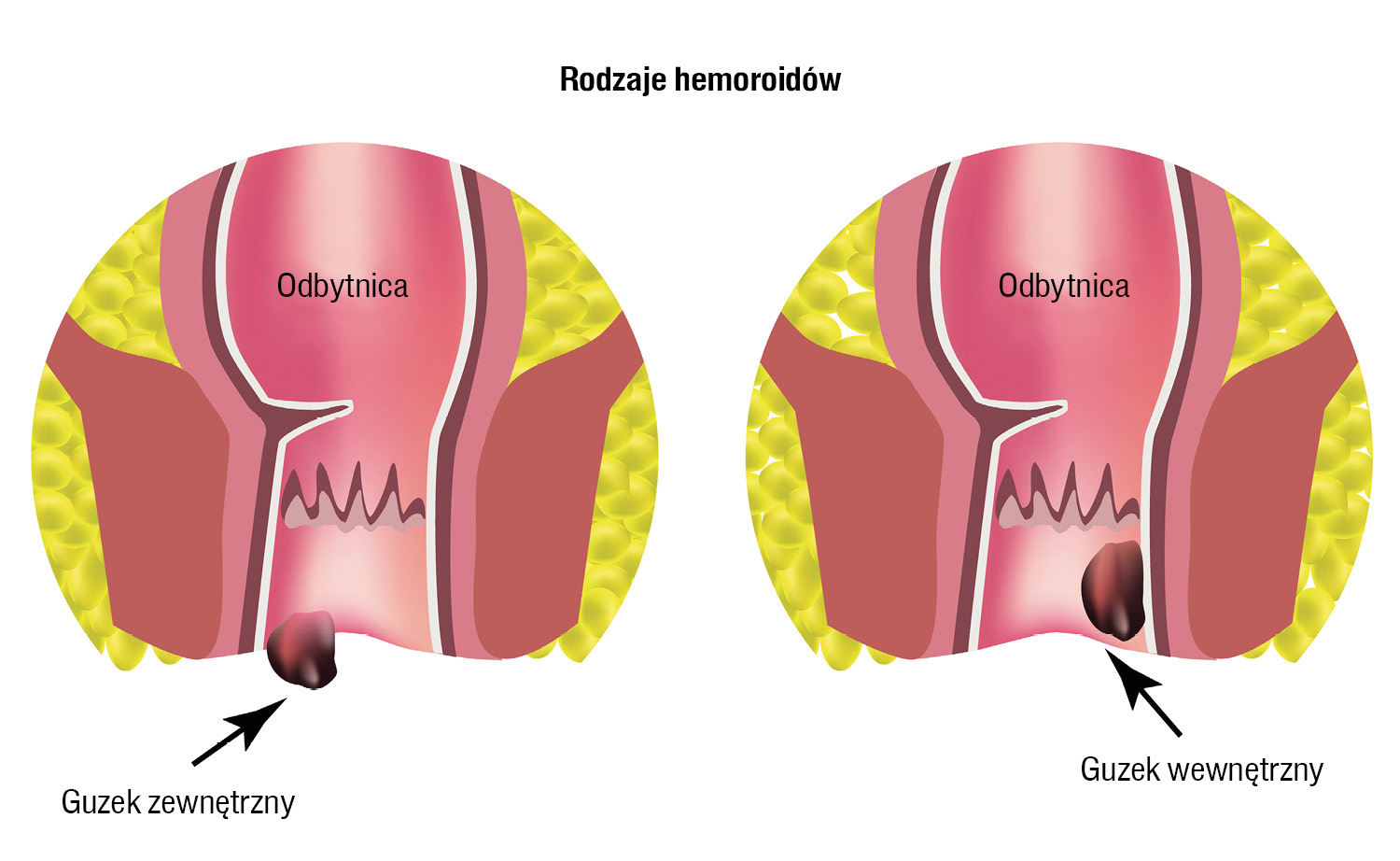 Chirurgia Po Dyplomie Hemoroidy